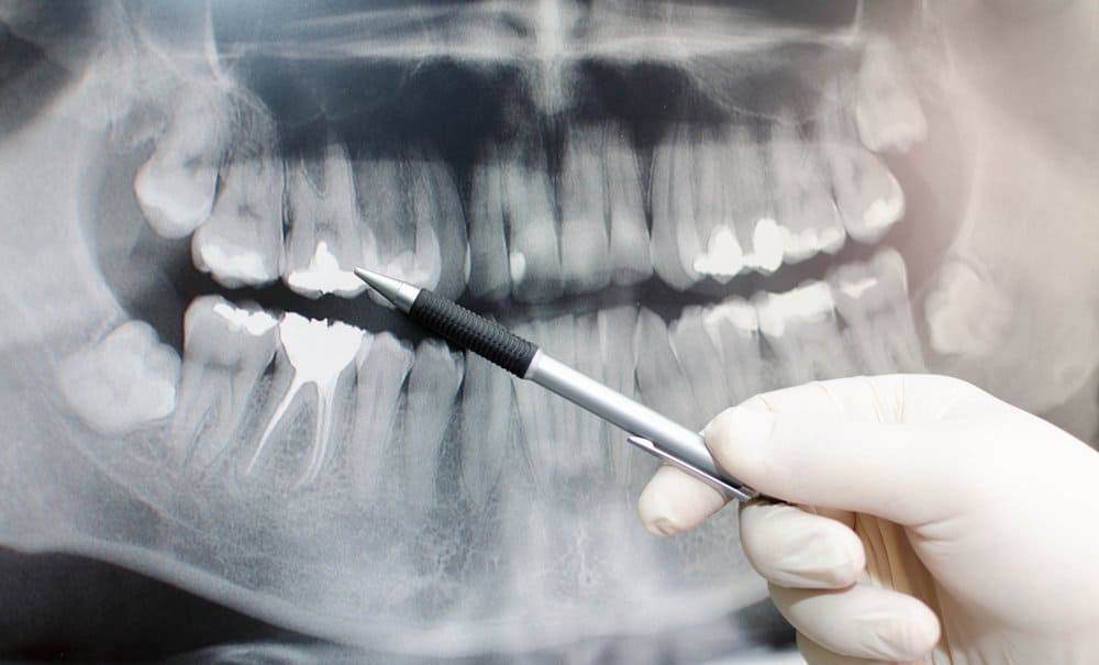 Gentle Ray – Dental Caries-Diagnosis