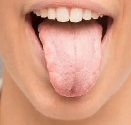Leukoplakia Bangalore