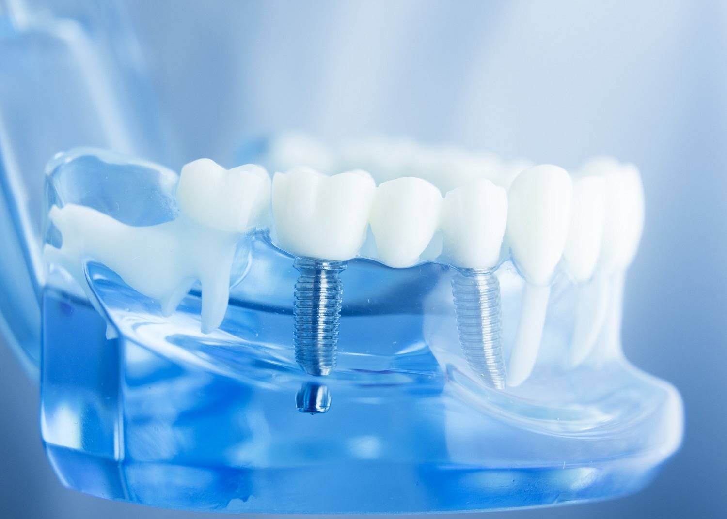 Dental Bridges