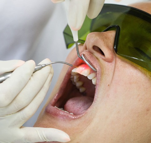 Laser in Root Canal Treatment​