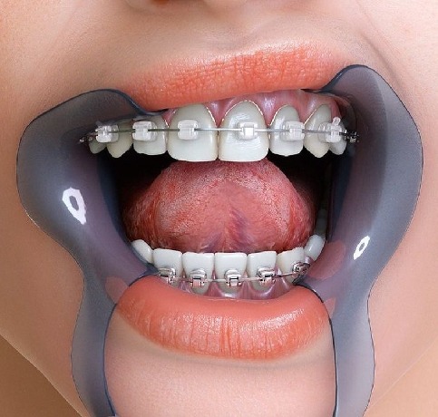 Digital Smile Design Bangalore