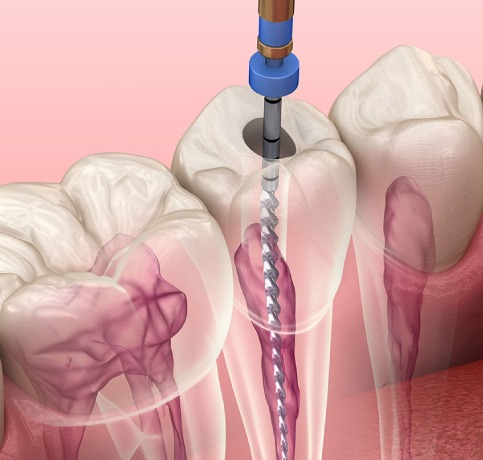 Dental Crowns Bangalore