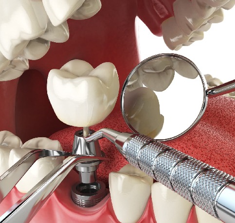 Dentures in Bangalore