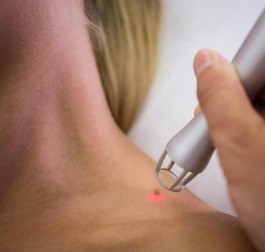 Mole & Warts Removal