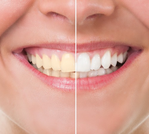 Laser Teeth Whitening Bangalore
