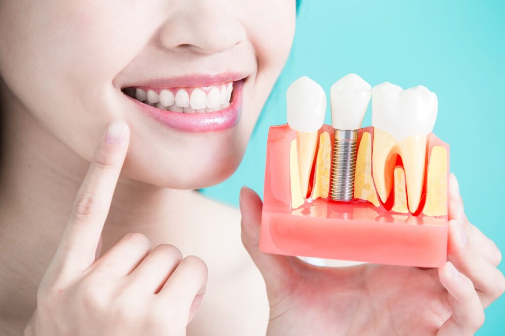 Dental Implants in Bangalore