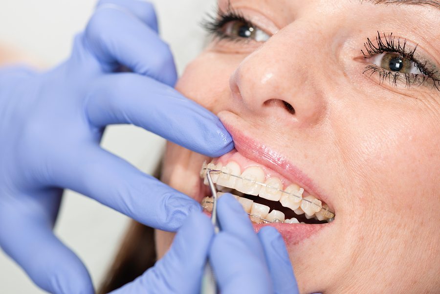 Invisalign in Indranagar