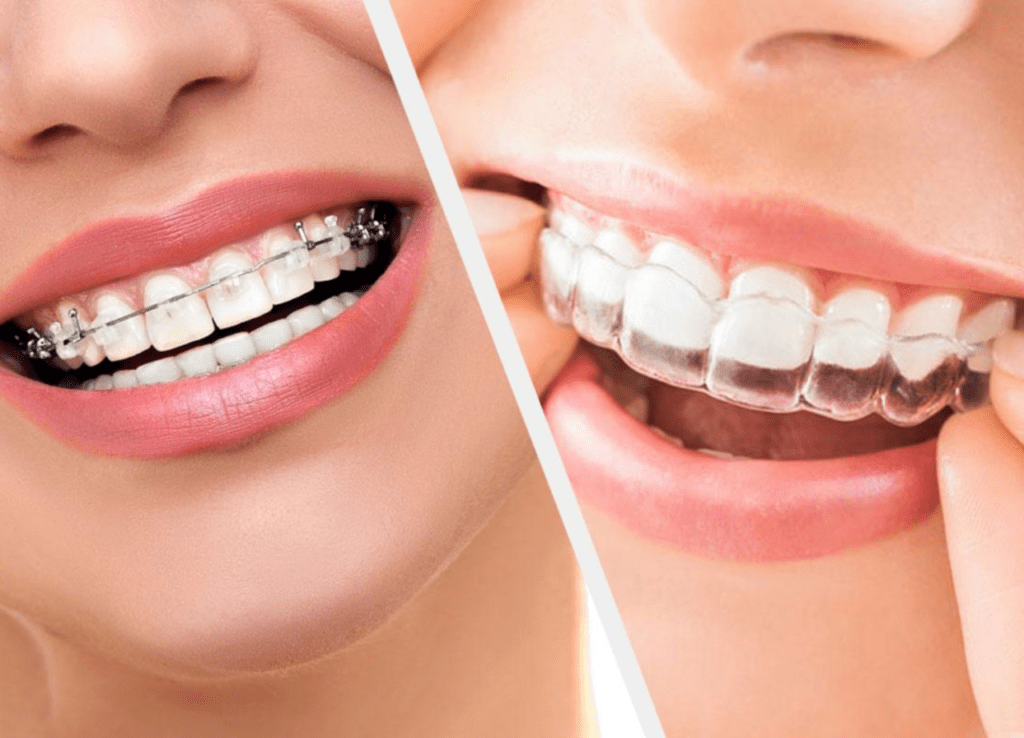 Invisible Braces