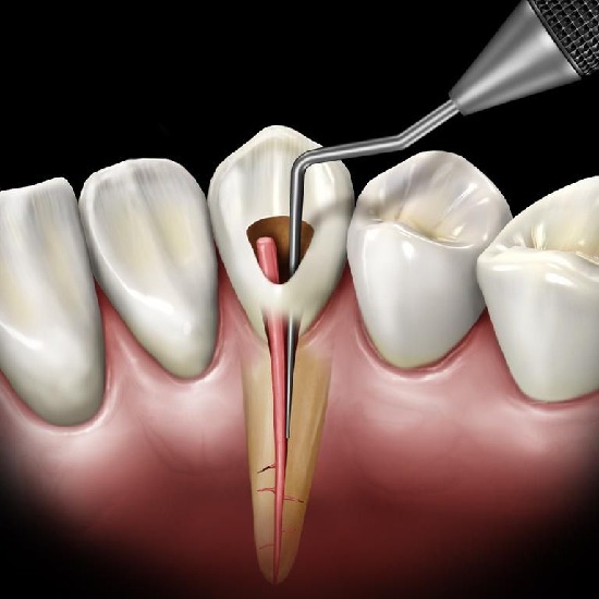 Endodontist in Indranagar