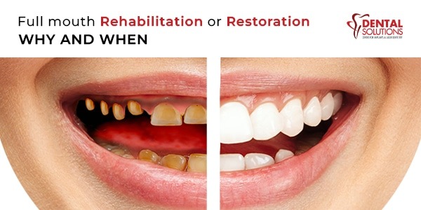Full Mouth Rehabilitation