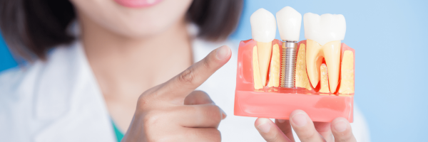 Dental Implants in Bangalore
