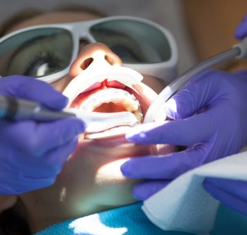 Root Canal Treatment