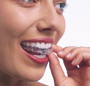 Invisible Braces Bangalore