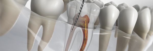 Root canal treatment in Bangalore